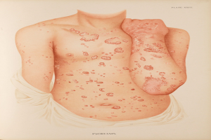Ein Buchumschlag mit einer Illustration eines Mannes mit roten Flecken, die wahrscheinlich Psoriasis darstellen, neben Text zum Thema.
