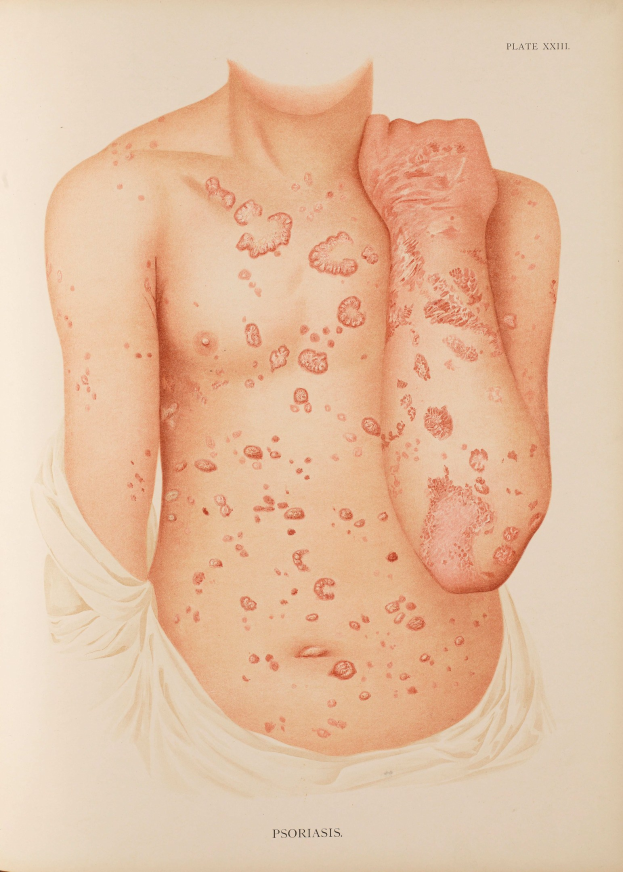 Ein Buchumschlag mit einer Illustration eines Mannes mit roten Flecken, die wahrscheinlich Psoriasis darstellen, neben Text zum Thema.